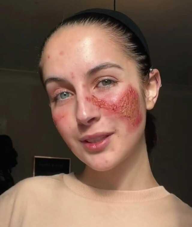 Kendisine karşı alerjisi olan kadın, güldüğünde yüzü yanıp yara oluyor Kendisine karşı alerjisi olan kadın, güldüğünde yüzü yanıp yara oluyor