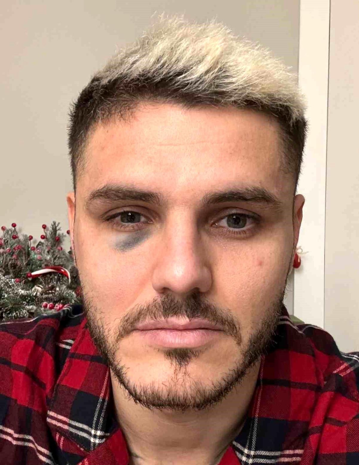 Galatasaray, Fenerbahçe Derbisinde Mauro Icardi'nin Gözünün Morardığı Fotoğrafı Paylaştı