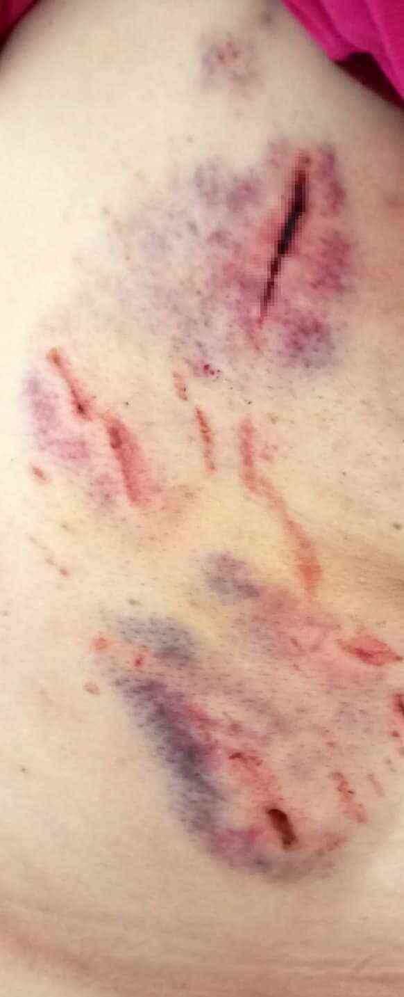 Köpeklerin saldırısına uğrayan kadın: Ben o an öldüğümü sandım