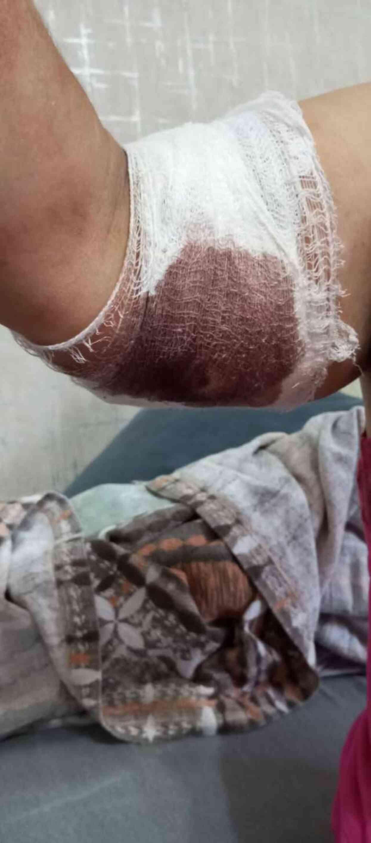 Köpeklerin saldırısına uğrayan kadın: Ben o an öldüğümü sandım