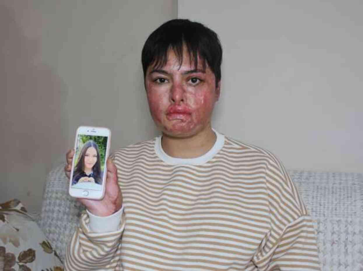 7 ayda 15 ameliyat geçirdi! Vücudunun yüzde 80'i yanan liseli Beyzanur'un son görüntüsü yürek burktu 7 ayda 15 ameliyat geçirdi! Vücudunun yüzde 80'i yanan liseli Beyzanur'un son görüntüsü yürek burktu