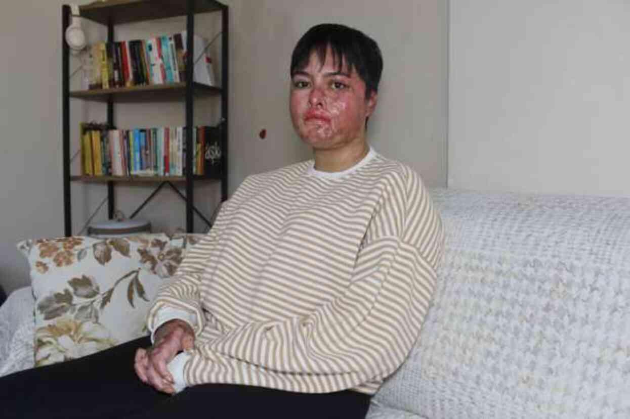 7 ayda 15 ameliyat geçirdi! Vücudunun yüzde 80'i yanan liseli Beyzanur'un son görüntüsü yürek burktu 7 ayda 15 ameliyat geçirdi! Vücudunun yüzde 80'i yanan liseli Beyzanur'un son görüntüsü yürek burktu