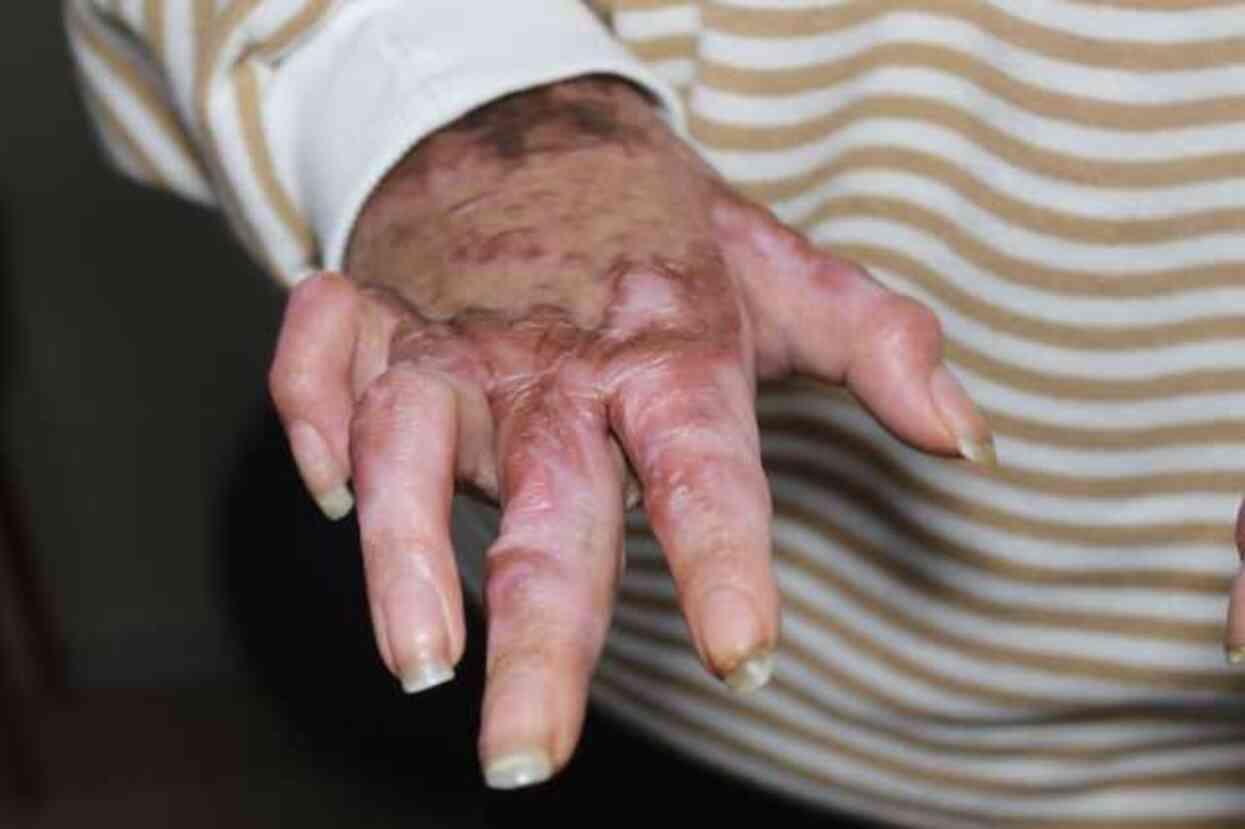 7 ayda 15 ameliyat geçirdi! Vücudunun yüzde 80'i yanan liseli Beyzanur'un son görüntüsü yürek burktu 7 ayda 15 ameliyat geçirdi! Vücudunun yüzde 80'i yanan liseli Beyzanur'un son görüntüsü yürek burktu