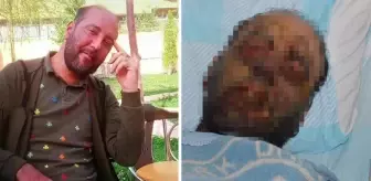 Yağmur ormanlarında görülen hastalık Erzurum'da: Kimsenin yüzüne bakamıyorum