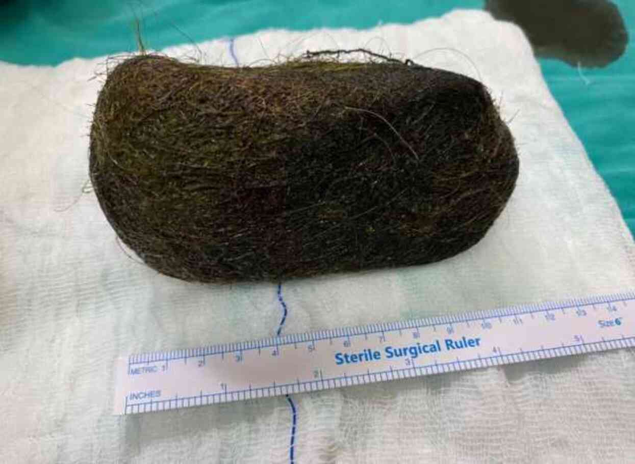 Hastanın midesinden 2 kilo saç kütlesi çıkarıldı Hastanın midesinden 2 kilo saç kütlesi çıkarıldı
