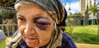 Antalya'da Zihinsel Engelli Kadın Diyaliz Merkezinde Saldırıya Uğradı