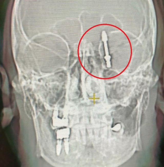 Diş ameliyatında implant vidası beyne saplandı! Hasta ölümden döndü