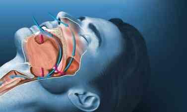 UYKU APNESİNE HANGİ BÖLÜM BAKIYOR? Uyku apnesi nedir, belirtileri neler?