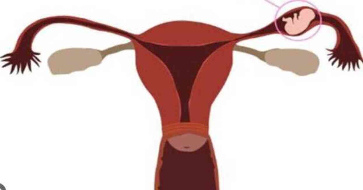 Dış gebelik nedir? Dış gebelik belirtileri neler?