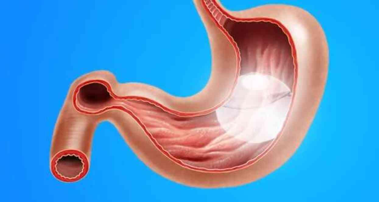 Mide Balonu ile Kilo Verme: 1 Ayda Kaç Kilo Verilir, Kimlere Takılmaz? Mide Balonu ile Kilo Verme: 1 Ayda Kaç Kilo Verilir, Kimlere Takılmaz?