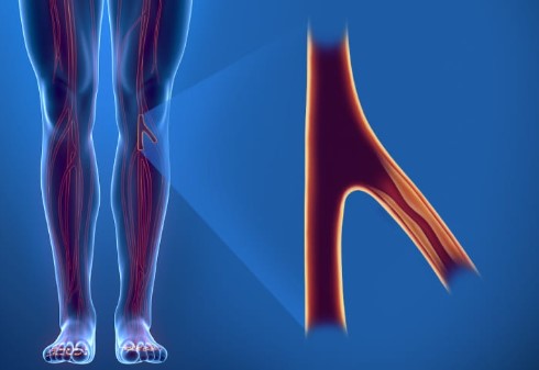 Bacak Damar Tıkanıklığı Nedir? Bacak damar tıkanıklığı kalbi etkiler mi?