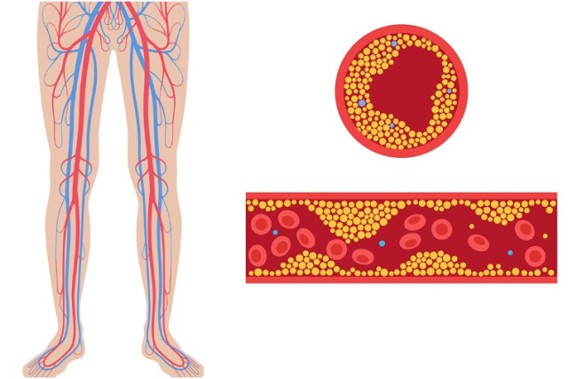 Bacak Damar Tıkanıklığı Nedir? Bacak damar tıkanıklığı kalbi etkiler mi?
