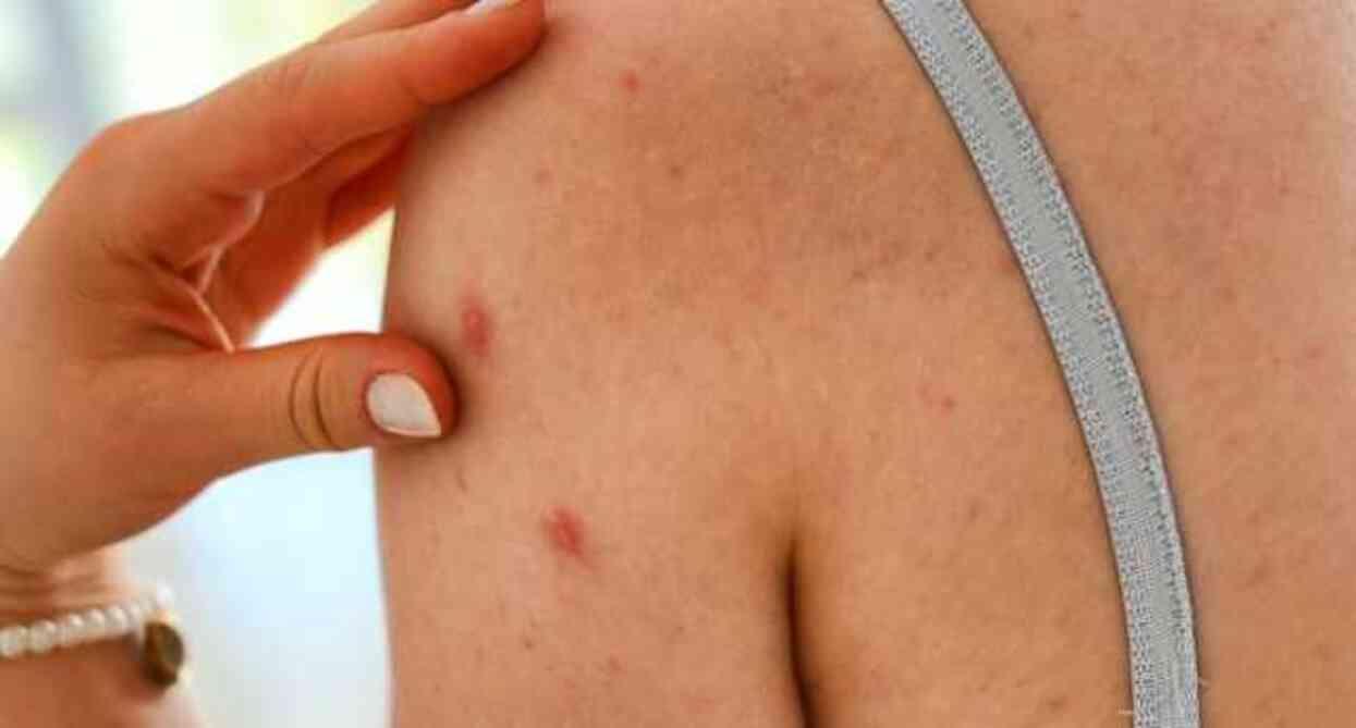 ZONA NEDEN OLUR? Zona (GECE YANIĞI) nedir, belirtileri neler?