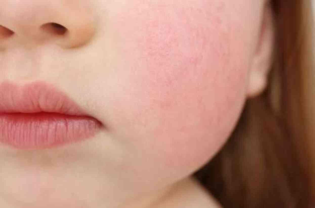 Beşinci hastalık nedir? Belirtileri ve tedavi yöntemleri nelerdir? Beşinci hastalık nedir? Belirtileri ve tedavi yöntemleri nelerdir?