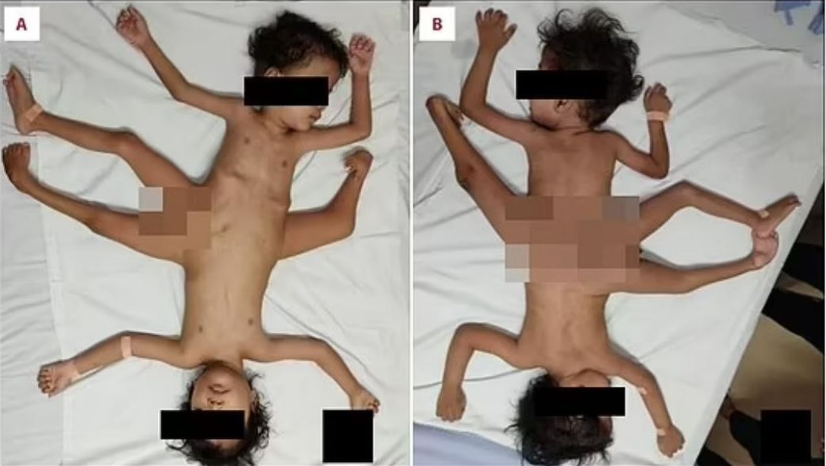 Endonezya'da üç bacağı, dört kolu olan siyam ikizler dünyaya geldi