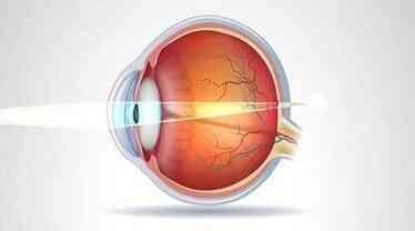 Hipermetrop nedir? Belirtileri ve tedavi yöntemleri nelerdir?