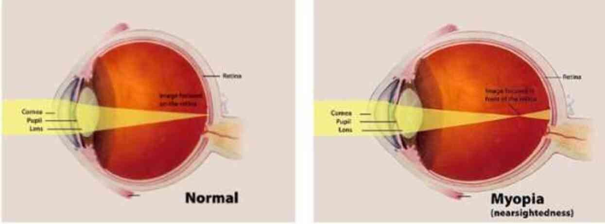 Miyop Nedir? Miyop Belirtileri, Nedenleri ve Tedavisi