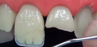 Diş şeffaflaşması neden olur? Dişte şeffaflık nasıl geçer?