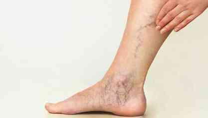 VARİS NEDEN OLUR? Varis nedir, nasıl geçer?