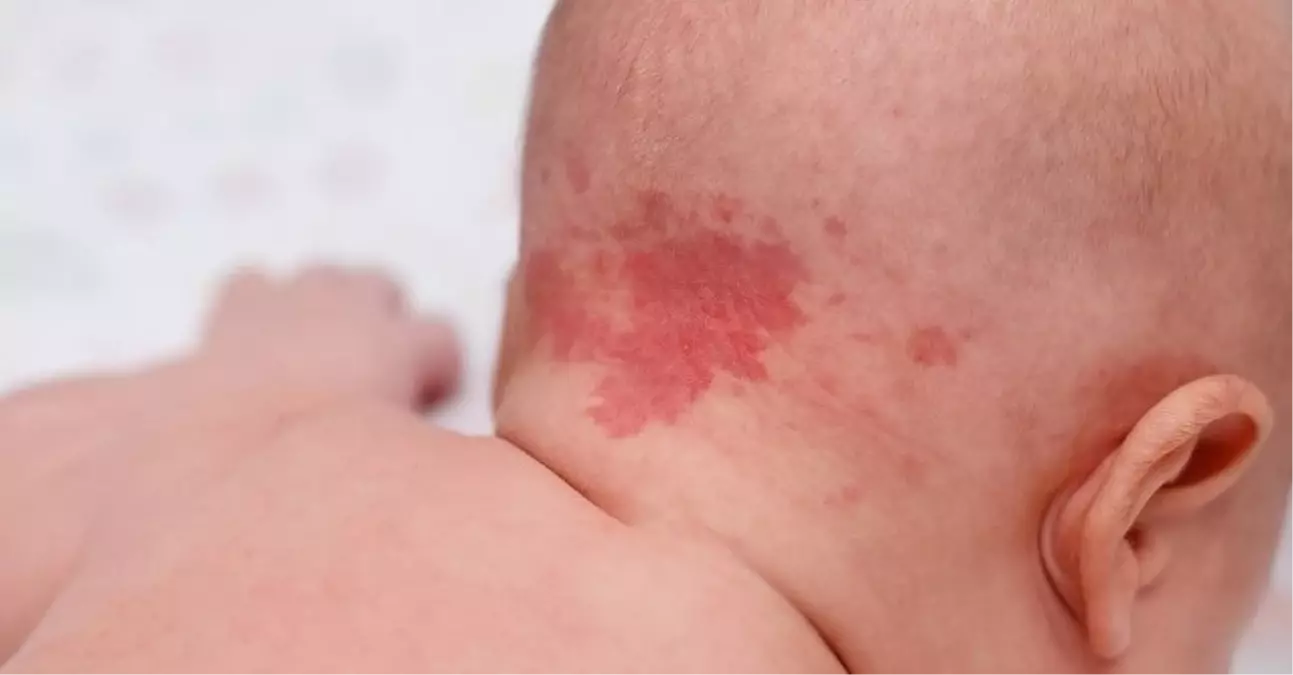 DOĞUM LEKESİ NEDEN OLUR? Doğum lekesi çeşitleri neler?