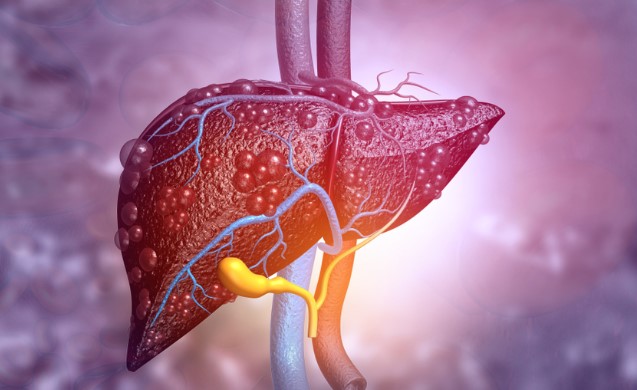 KARACİĞER YAĞLANMASI NEDEN OLUR? Karaciğer yağlanması belirtileri neler, nasıl önlenir?