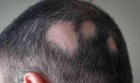 SAÇKIRAN NEDEN OLUR? Saçkıran belirtileri neler? SAÇKIRAN NEDEN OLUR? Saçkıran belirtileri neler?