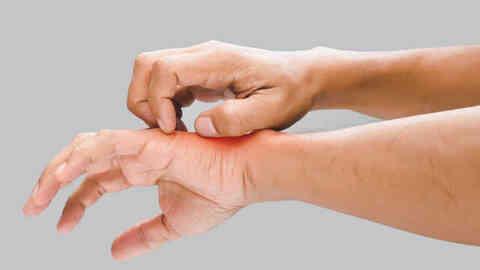 Kelebek hastalığı nedir, neden olur? Lupus hastalığı belirtileri ne, nasıl tedavi edilir? Kelebek hastalığı nedir, neden olur? Lupus hastalığı belirtileri ne, nasıl tedavi edilir?