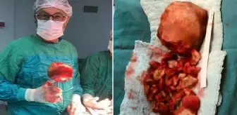 Ağrı şikayetiyle gitti, mesanesinden 1 kilogramlık taş çıkarıldı