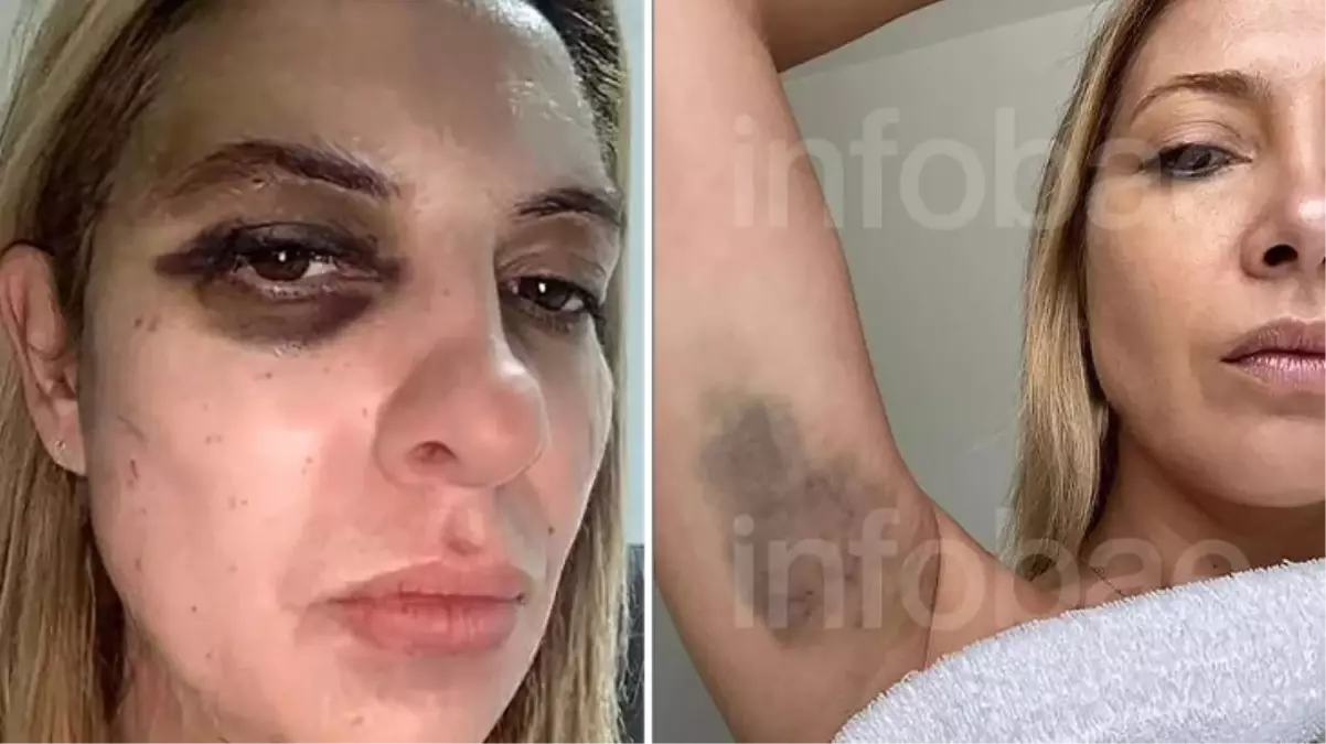 Eski Arjantin Devlet Başkanı Alberto Fernandez, karısını hastanelik etti