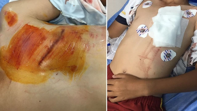 The exposed construction iron got stuck in the chest of the little child.