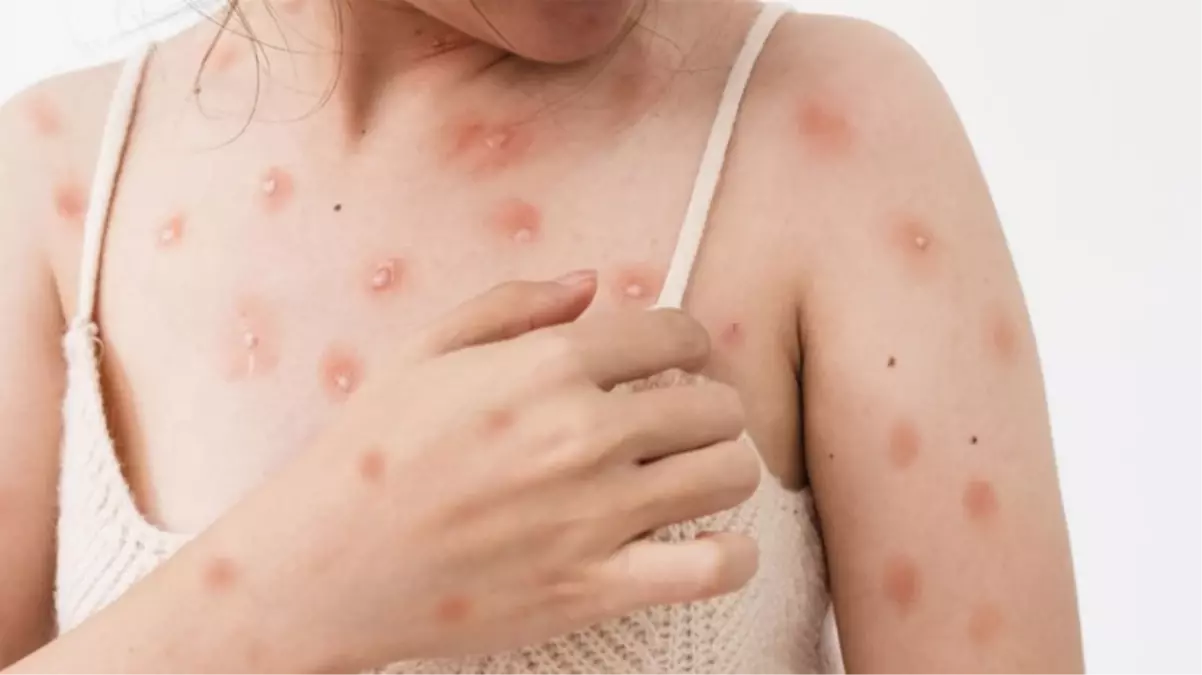 Maymun çiçeği virüsü Avrupa'ya sıçradı! Daha bulaşıcı varyantı İsveç'te görüldü