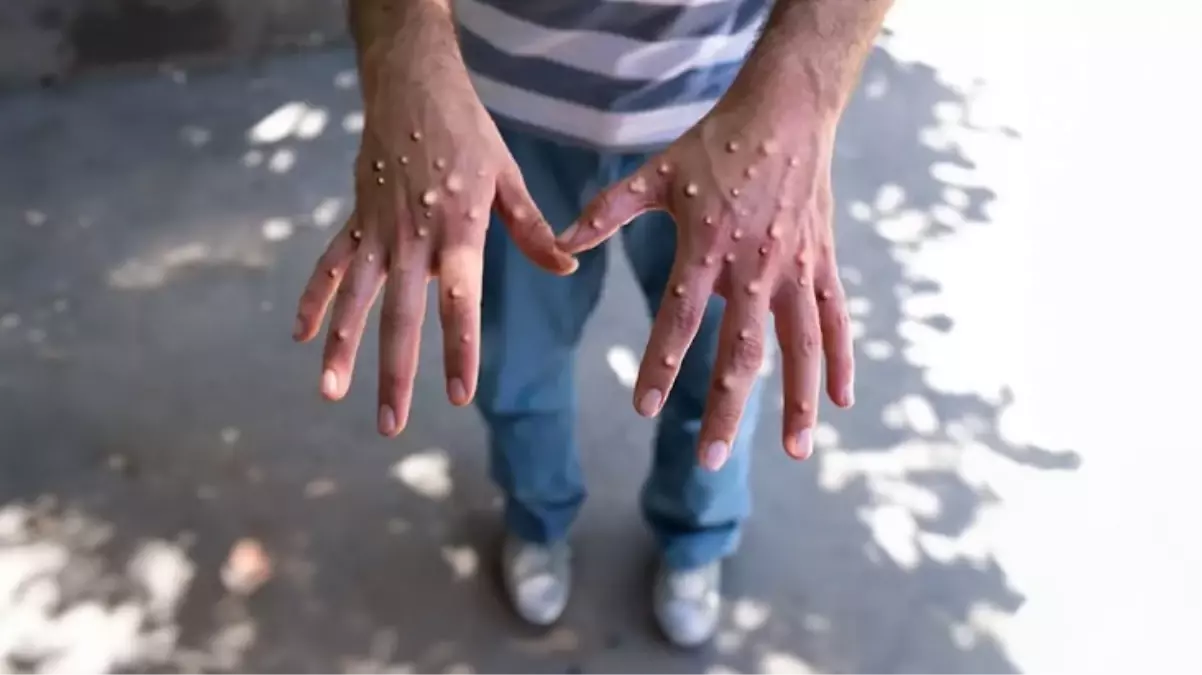 İlk vakayı doğruladılar! Maymun çiçeği virüsü Avrupa'ya sıçradı