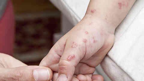 Maymun çiçeği virüsü belirtileri neler? Maymun çiçeği virüsü Türkiye'ye var mı? Maymun çiçeği virüsü nedir? Maymun çiçeği virüsü belirtileri neler? Maymun çiçeği virüsü Türkiye'ye var mı? Maymun çiçeği virüsü nedir?