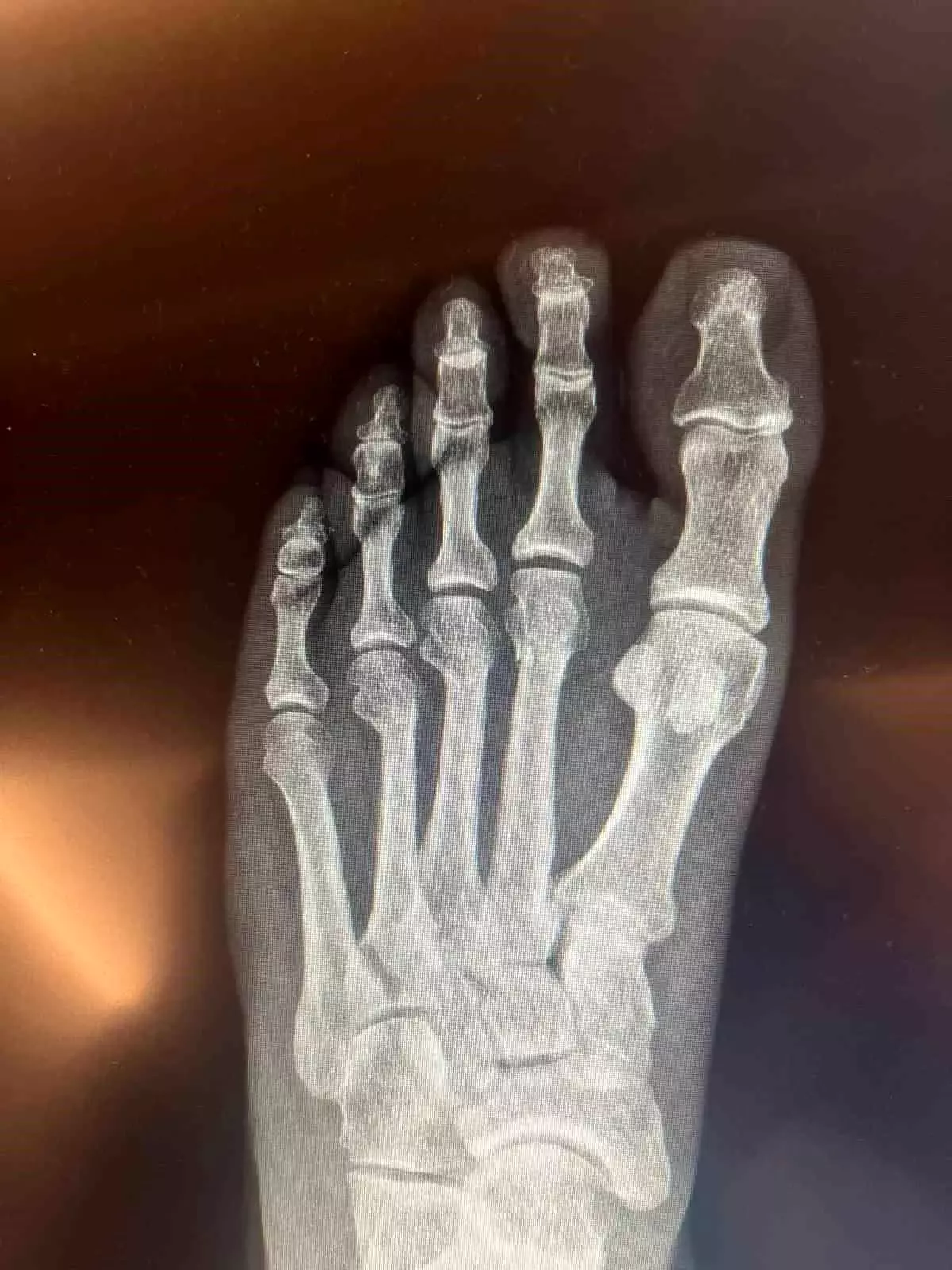 CHP Genel Başkanı Özgür Özel'in ayağının röntgen filmleri paylaşıldı