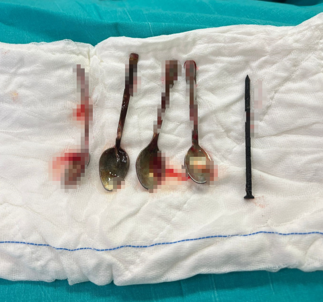 4 metal spoons and 1 nail removed from the stomach of the child who applied to the hospital in Kayseri with complaints of stomach pain