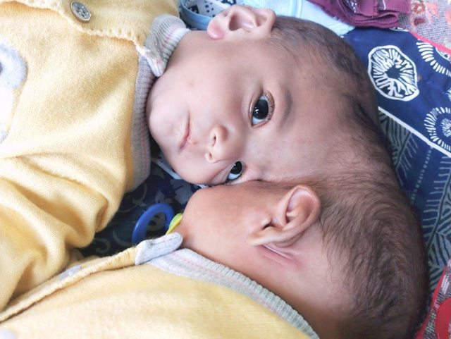 Conjoined Twins Separated by President Erdogan's Order