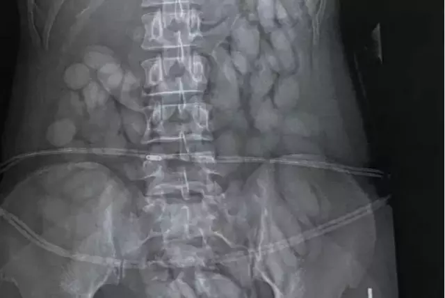 A woman was arrested in South Africa with a large number of drug capsules in her stomach.