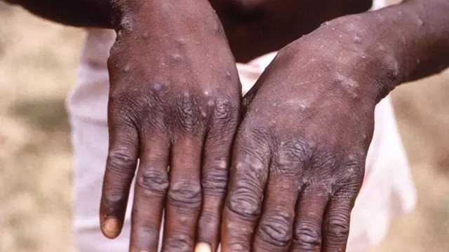 The first cases of monkeypox have been detected in Zimbabwe and Zambia.