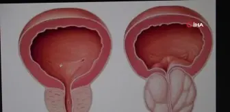 İyi Huylu Prostat Büyümesi Tedavisinde HoLEP Ameliyatı ile Yeni Bir Dönem