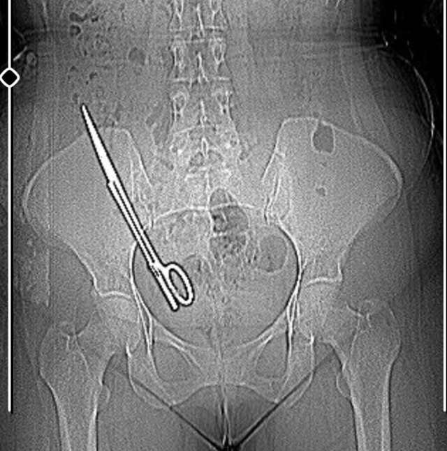 Baş ağrısı şikayetiyle gitti, karnından 16 cm uzunluğunda makas çıktı