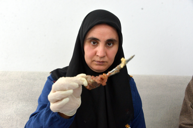 Baş ağrısı şikayetiyle gitti, karnından 16 cm uzunluğunda makas çıktı