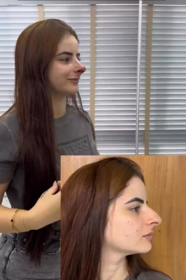 Her appearance after the nose job surprised everyone! 'The old one was better' comments are being made