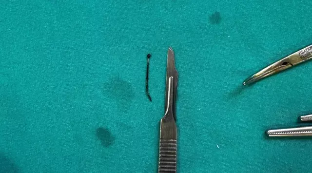 The pin that came out from the child's bladder shocked even the doctors