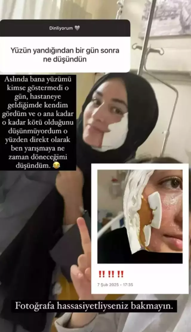 MasterChef Beyza shared a photo of her burned face with the note 'Sensitive content'