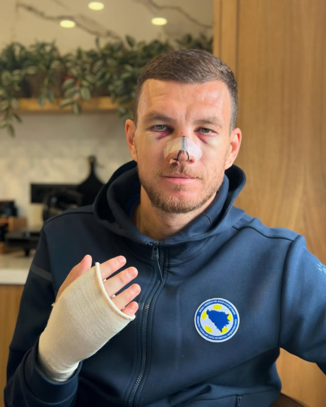 The minister can't look again! The latest state of Edin Dzeko's face, whose nose is broken, is terrible