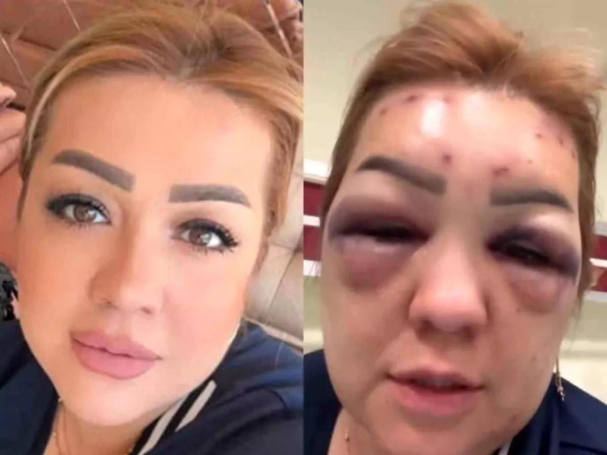 Kahramanmaraş'ta Botoks Sonrası Yüzü Şişen Kadın Hastanelik Oldu