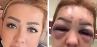 Güzelleşmek için gittiği estetik merkezinde kabusu yaşadı