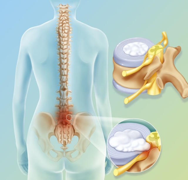 Lomber disk hernisi nedir, neden olur? Lomber disk hernisi belirtileri nelerdir? Lomber disk hernisi nedir, neden olur? Lomber disk hernisi belirtileri nelerdir?
