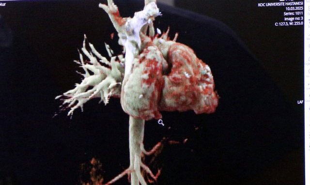 Born with a 'horizontal' heart, she regained health with the first surgery performed in Turkey; the second case in the world