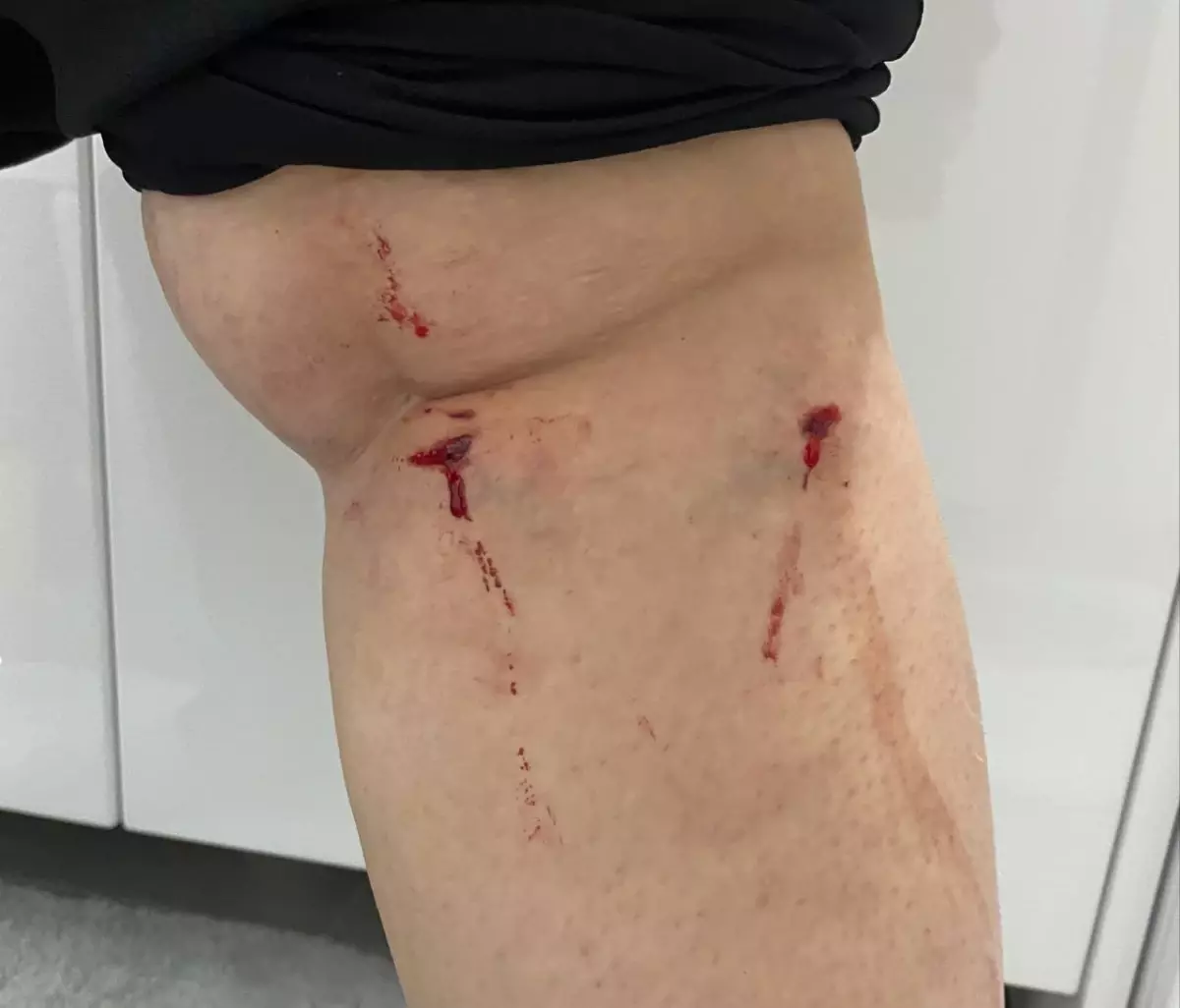 Sokak Köpeklerinin Saldırısına Uğrayan Öğrenci Hastaneye Kaldırıldı